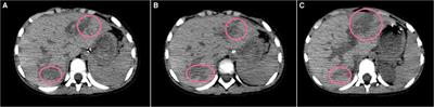 Severe Blunt Liver Injury Complicated by Delayed Massive Hemobilia in a Toddler: A Case Report and Literature Review